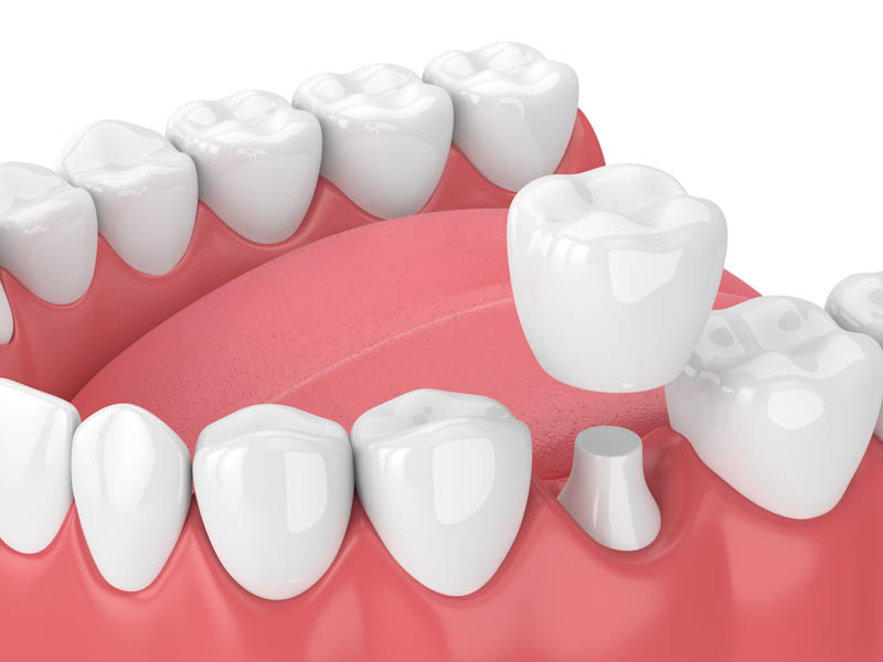 Premium Dental Crowns in Cool Springs