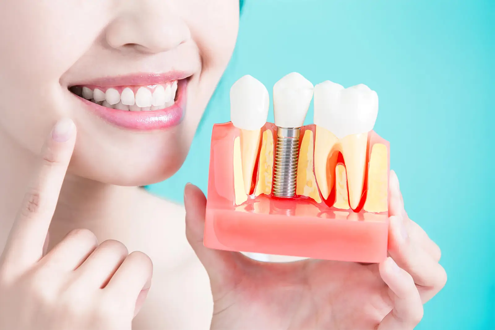 Dental Implants