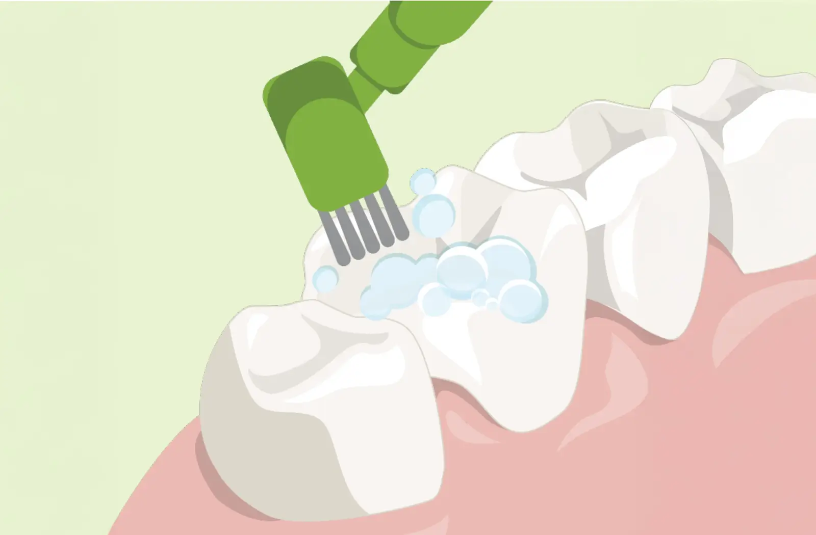 Dental-Sealants-Step-1