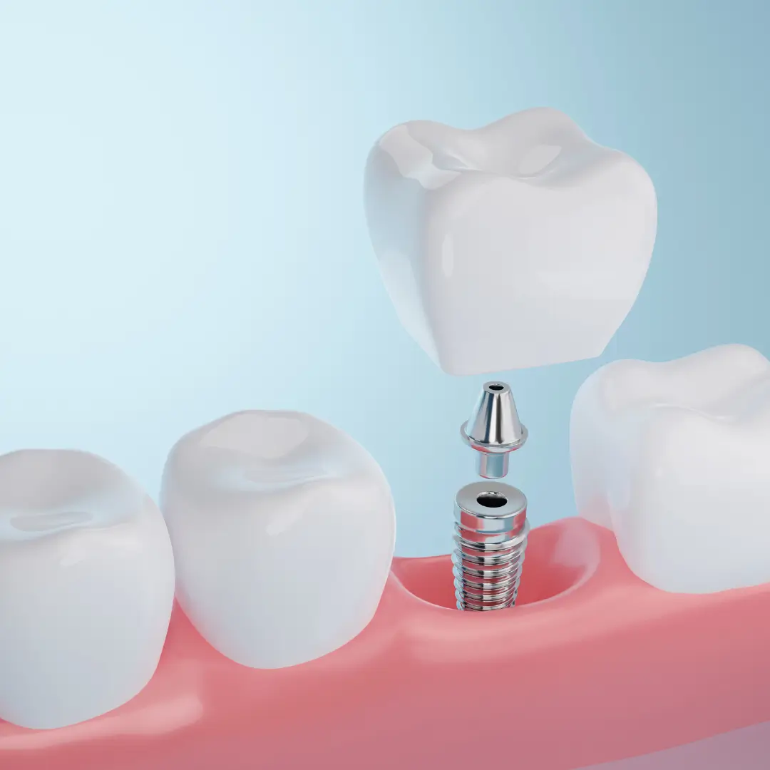 Implants