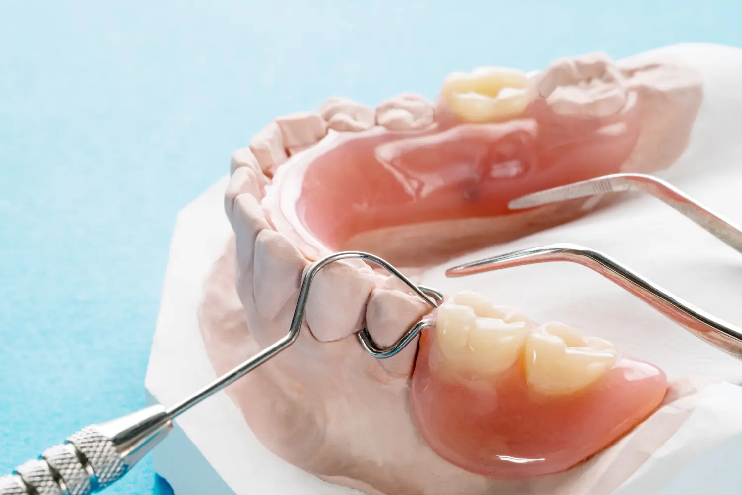 Dental Bridges