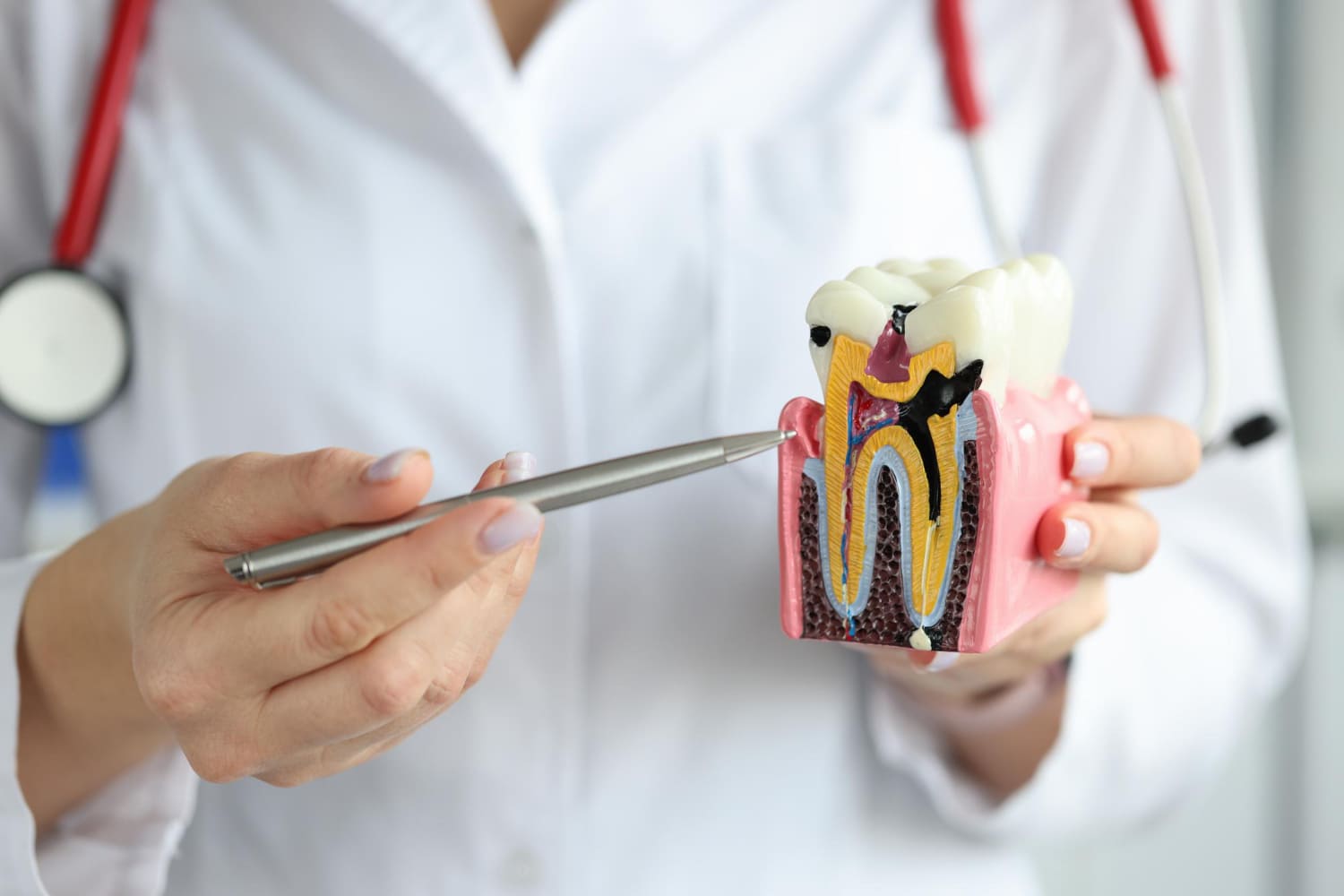 doctor-showing-carious-cavity-with-ballpoint-pen-plastic-artificial-tooth-model-closeup